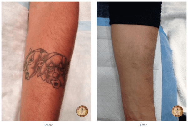 Laser Tattoo Removal - Pacific Plastic Surgery Group